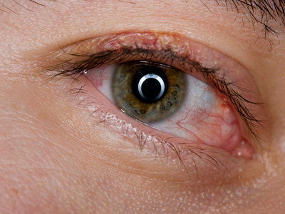 Blepharitis