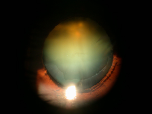 cataracts