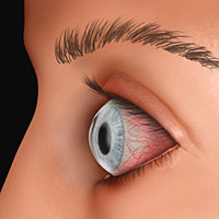 dry eye